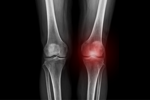 Vitamin K Can Reduce the Risk of Bone Fractures